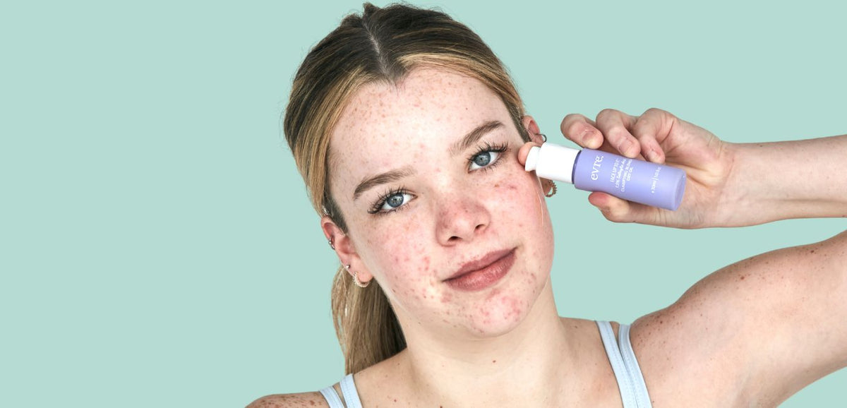 Blog cover: How to Break Up With Acne: The Magic of Oil-Based Treatments