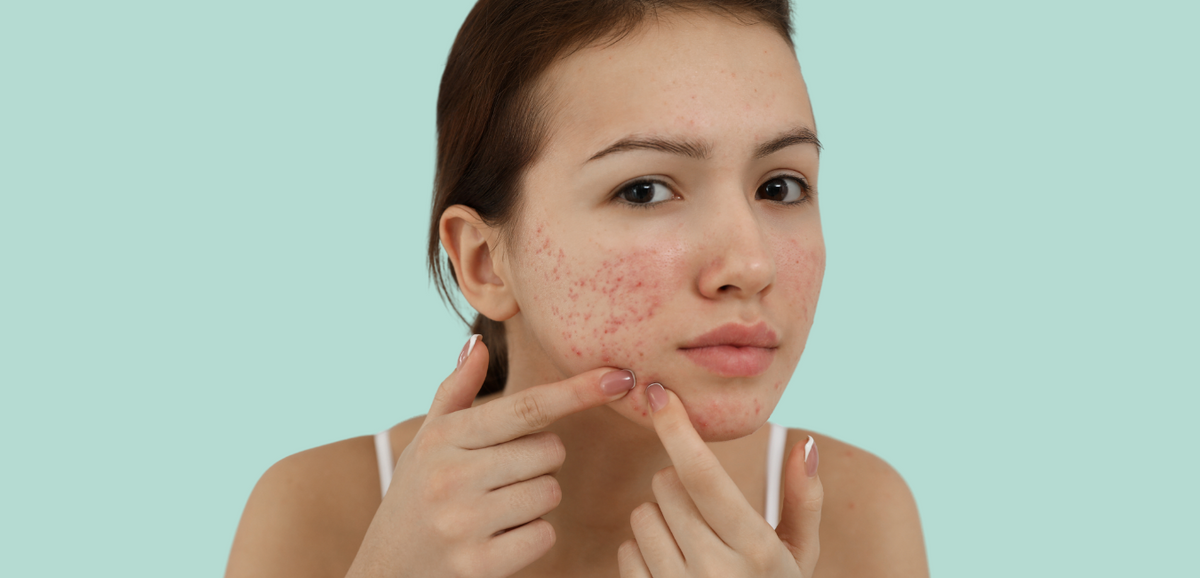 Blog cover: Decoding Breakouts: Unveiling the Secrets of Blemishes