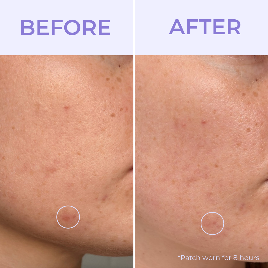 Stick with Me Pimple Patches