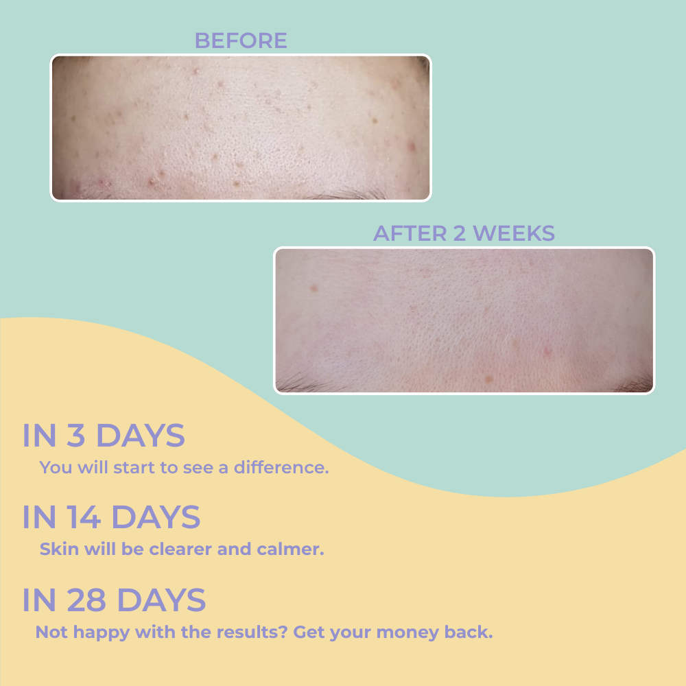 3-Step Blemish Treatment Bundle