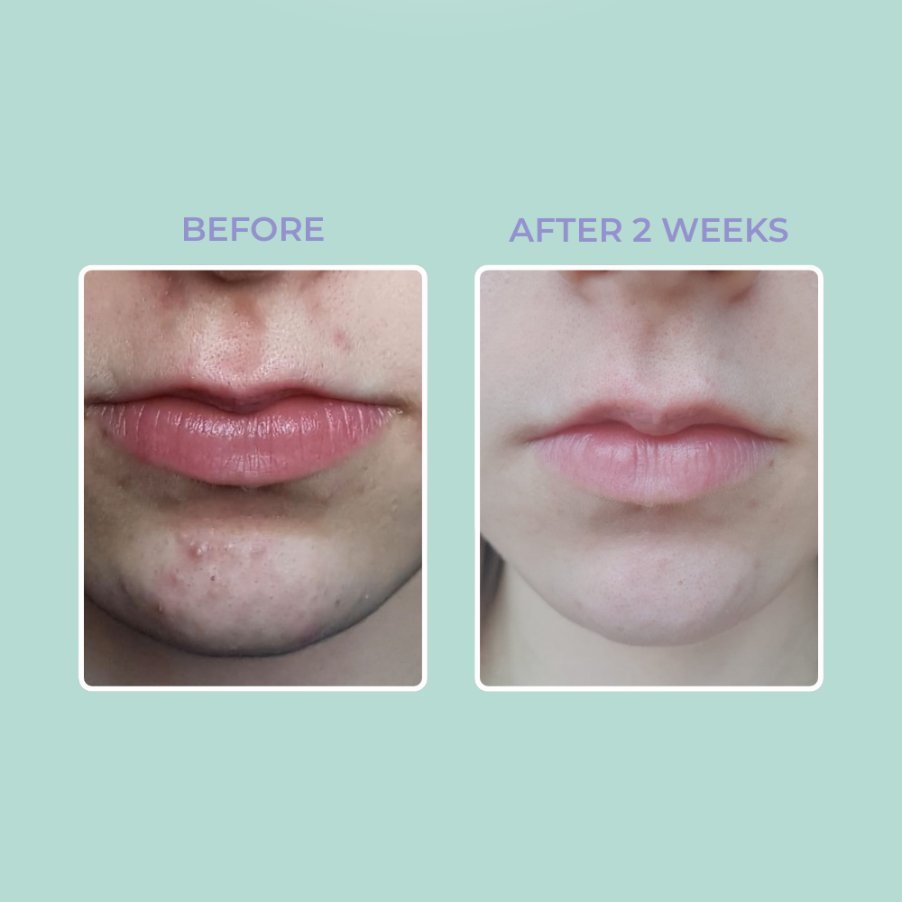 3-Step Blemish Treatment Bundle