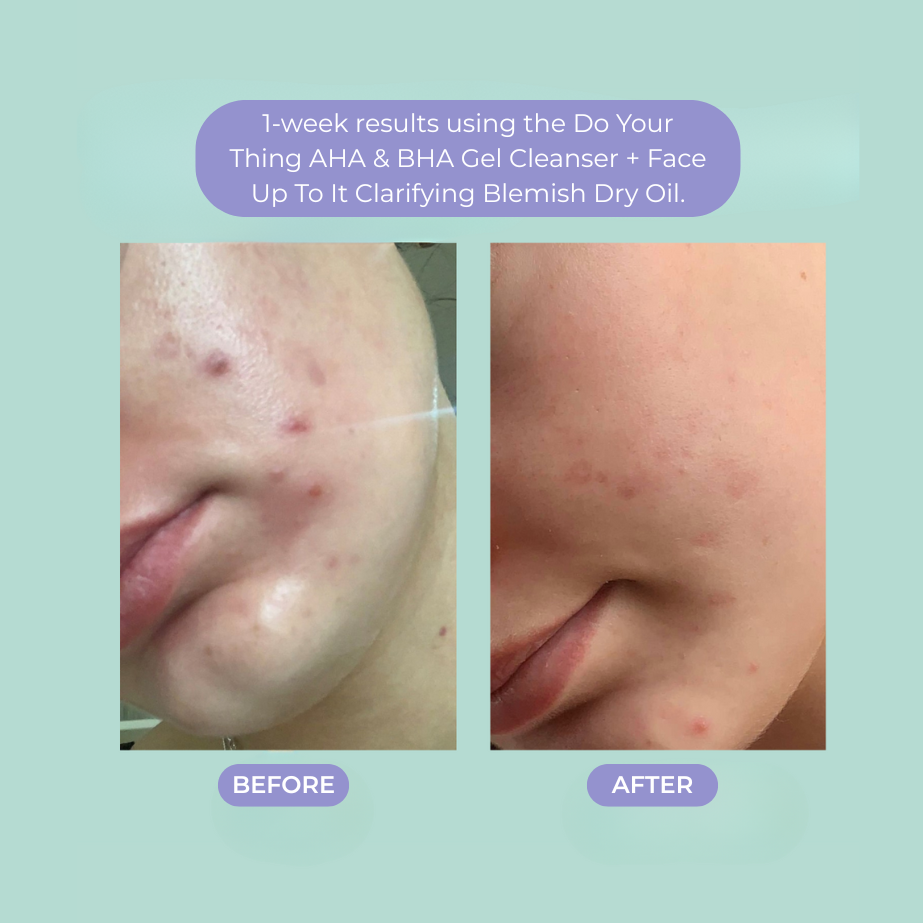 3-Step Routine Blemish Treatment Bundle