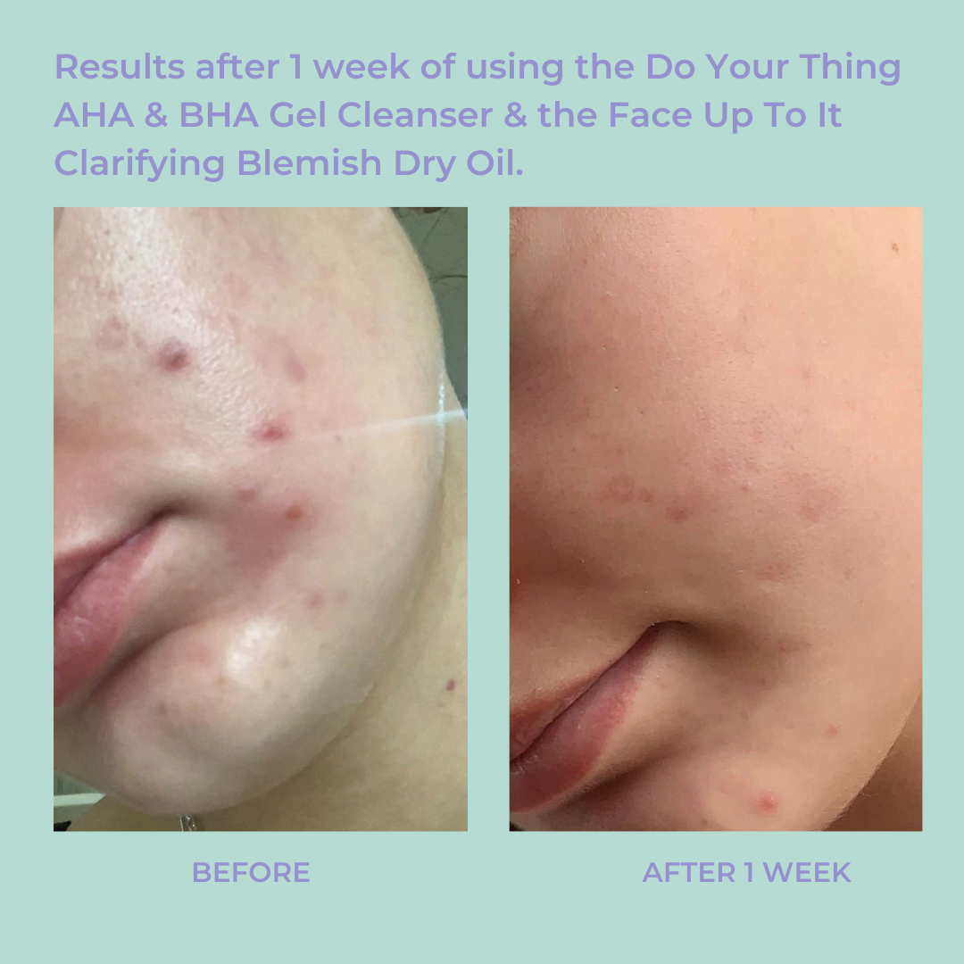 Face Up To It Clarifying Blemish Dry Oil 1 fl oz